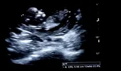 Incredibil! Ce a arătat ecografia unei gravide cu gemeni – VIDEO
