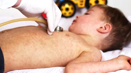 Rujeola, o boală ce poate fi prevenită prin vaccinare, a luat 200 de mii de vieți în 2019