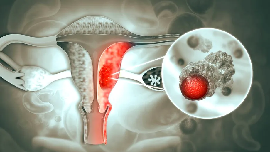 Peste 40% dintre femeile cu cancer ovarian află diagnosticul abia după o urgență medicală. Simptome pe care nu trebuie să le ignori, de la balonare persistentă, la urinări frecvente