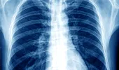 Dr. Cătălin Costovici: „Riscul dezvoltării unui cancer pulmonar este mai mare la persoanele care cumulează mai mulţi factori de risc”