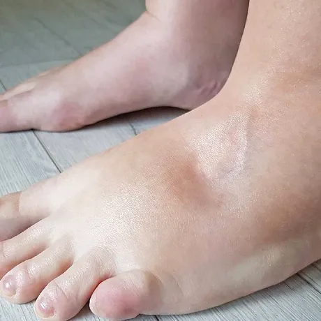 Corpul tău pare umflat fără motiv: adevărul despre retenția de apă