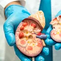 Apa pe care mulți români o beau zilnic poate crește riscul unor forme de cancer. Avertismentul unui medic urolog