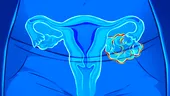 Cancerul ovarian atacă și fetele sub 18 ani! Factori de risc și primele semnale de alarmă