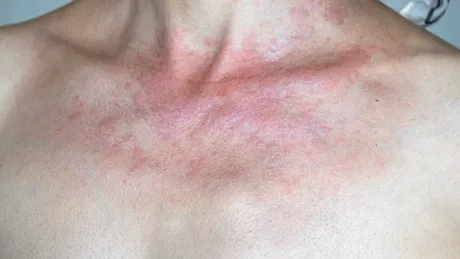 Femeie mutilată din cauza cremelor de față: „M-am trezit desfigurată!” Ce ingredient conținea produsul care a băgat-o în spital