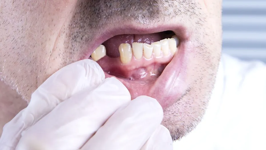 Parodontoza, boala care ne lasă fără dinți de la 30-40 de ani. Cum poate fi prevenită