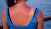 Arsurile solare nu sunt inofensive. Cinci episoade pot crește semnificativ riscul de cancer de piele