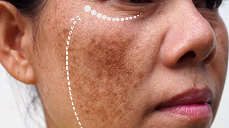 Elimină petele pigmentare de pe față cu acest fruct pe care îl cumperi de la supermarket cu 2 lei! Vei avea o piele perfectă