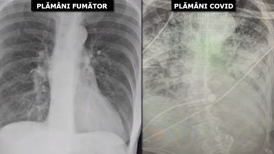 Plămâni de fumător versus plămâni COVID: cum arată radiografia pulmonară în cele 2 situații
