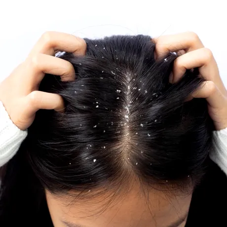 Cum să scapi de mătreață pentru totdeauna. Obiceiul sănătos pentru scalp