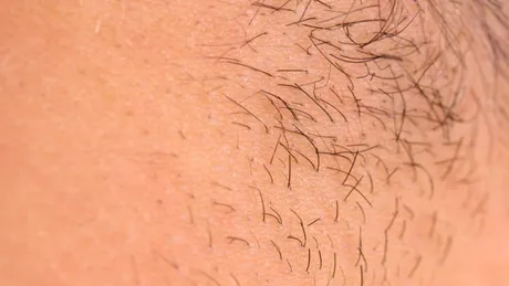 Hirsutismul: tratament