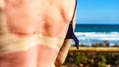 5 remedii naturale care calmează rapid arsurile solare. Ce poți aplica imediat pe piele