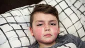 Un elev de 15 ani din Iași, suspect de scarlatină! Ce simptome trebuie să urmărească părinții, potrivit medicilor