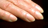 Semnul timpuriu de pe degete care ascunde cel mai temut cancer. Aproape 40% din bolnavi au acest simptom