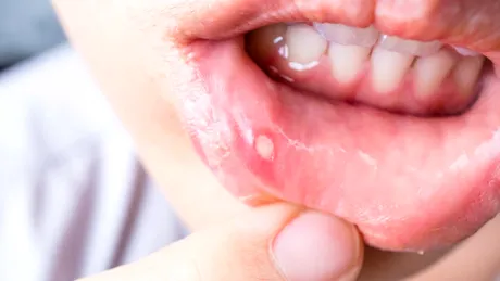 Aftele bucale - ce vitamine și minerale îți lipsesc dacă ai des această problemă