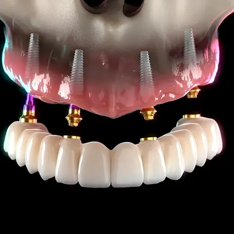 (P) Ai dinți lipsă sau porți o proteză mobilă? Află cum poți avea dinți ficși în 24 de ore