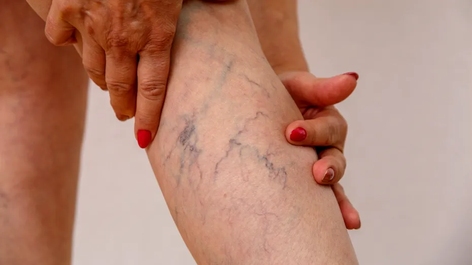 Scapă de varice cu un remediu natural care chiar funcționează
