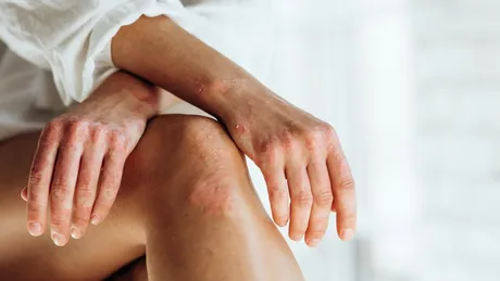 Remediu naturist împotriva psoriazisului: calmare și hidratare profundă cu ingrediente naturale