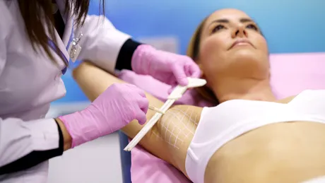 Ce trebuie să știi despre tratamentul cu toxină botulinică pentru hiperhidroză (transpirație excesivă)