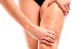 Ce să mănânci ca să scapi de celulită. Aspectul de coajă de portocală dispare rapid