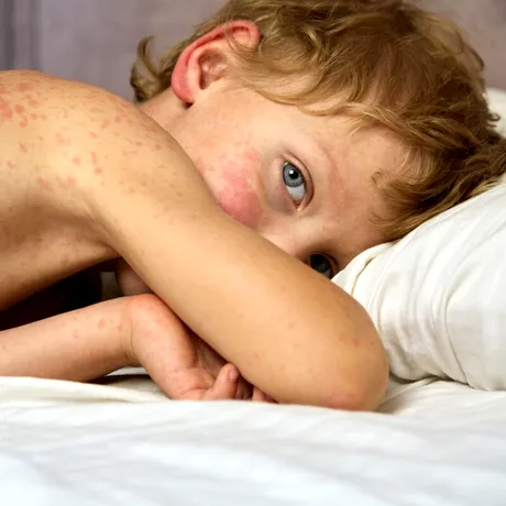 Organizația Mondială a Sănătății, noi alerte din cauza focarelor de rujeolă. România se plasează pe primul loc din Europa la numărul de îmbolnăviri și decese / VIDEO