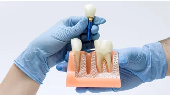(P) Îngrijirea după implant dentar: reguli simple care pot susține rezultatul pe termen lung