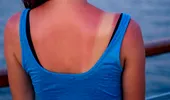 Cum să calmezi arsurile solare cu doar două ingrediente naturale