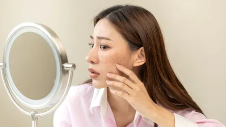 4 alimente care pot agrava acneea, potrivit unui medic dermatolog