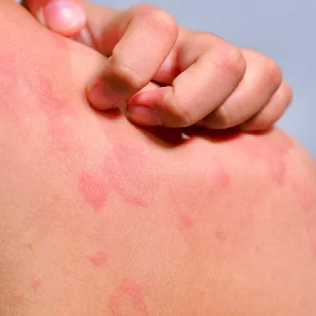 Urticaria cronică spontană: cât durează, de ce apare și când trebuie să mergi la medic