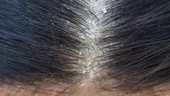 Ce ingrediente trebuie să conțină șamponul ca să scapi de mătreață. Trebuie neapărat să fie pe etichetă!