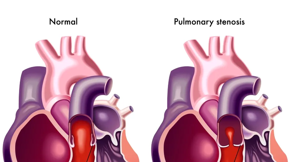 Stenoza pulmonară: simptome, cauze, tratament, prevenţie