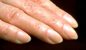 Semnul timpuriu de pe degete care ascunde cel mai temut cancer. Aproape 40% din bolnavi au acest simptom