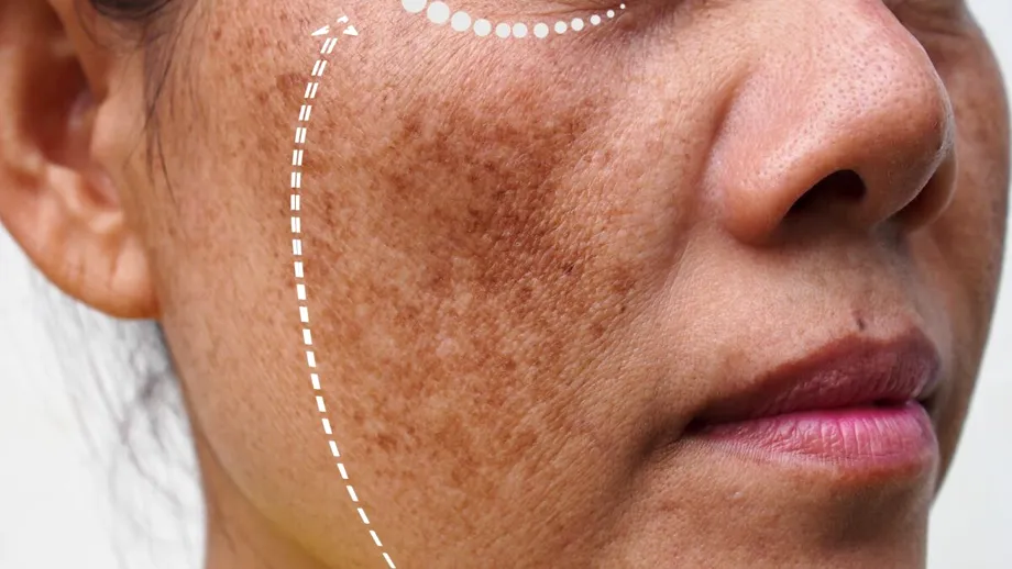 Cum îmbătrânește pielea. La 20 de ani se formează primele riduri, la 30-40 de ani apar petele pigmentare cauzate de soare