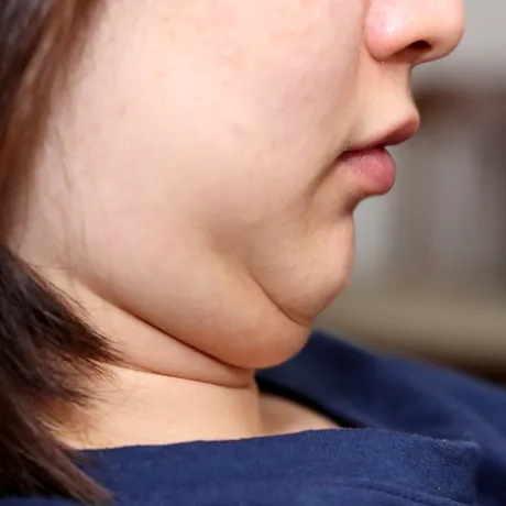 Cum să scapi de bărbia dublă definitiv, fără intervenții estetice