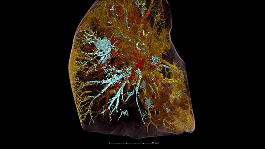 Imagini detaliate cu plămânii afectați de COVID. Tehnica imagistică de ultimă oră