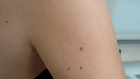 Alunițe normale sau alunițe cancerigene – principalele diferențe