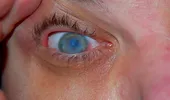 Cataracta, o boală a ochilor care afectează şi tinerii. Care sunt cauzele şi simptomele cataractei
