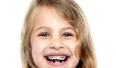 La ce vârstă este indicat aparatul dentar la copii