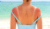 Cum îți calmezi arsurile solare. Amestecul care te scapă de usturimea insuportabilă