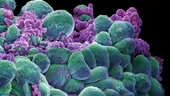 Metoda revolutionara: cancerul invins prin terapia cu ioni grei