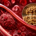 (P) Nattokinaza și prevenția trombozei – ce arată studiile clinice