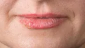 Herpes bucal versus herpes genital