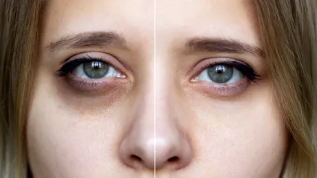 Scapă de cearcăne peste noapte cu două ingrediente care fac minuni