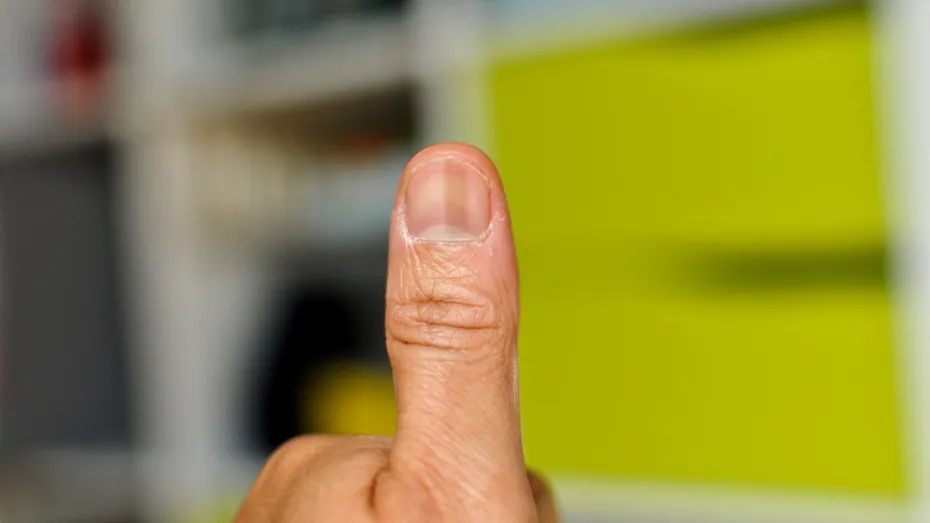 Un bărbat a stârnit îngrijorare în mediul online după ce a postat o poză cu degetul mare având un aspect ciudat