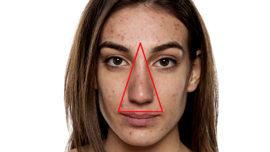 La ce pericol te expui dacă storci coșurile din „triunghiul morții”, o zonă foarte sensibilă de pe față