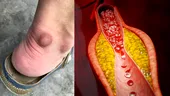 Ai observat aceste schimbări la ochi sau picioare? Pot avea legătură cu colesterolul