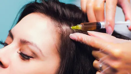 Terapia Vampir, nu doar pentru piele! Cum ajută tratamentul PRP creșterea părului