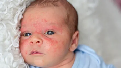 Dermatită atopică la nou născut - simptome (GALERIE FOTO)