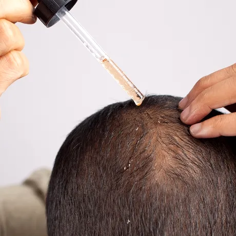 Minoxidil: beneficiile și riscurile utilizării tratamentului pentru regenerarea părului. Substanța, tot mai folosită și pentru sprâncene