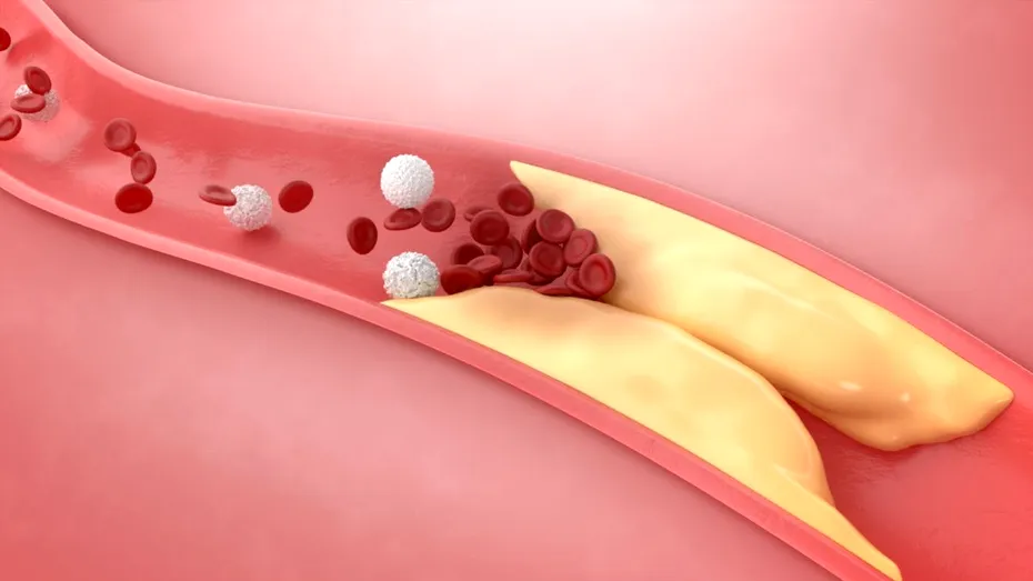 Colesterolul crescut la bărbați. Semnele ușor de identificat