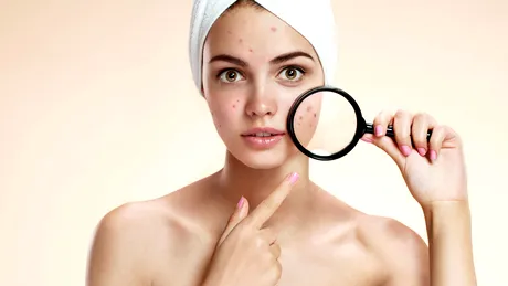 Cum să ţineţi acneea sub control - VIDEO by CSID